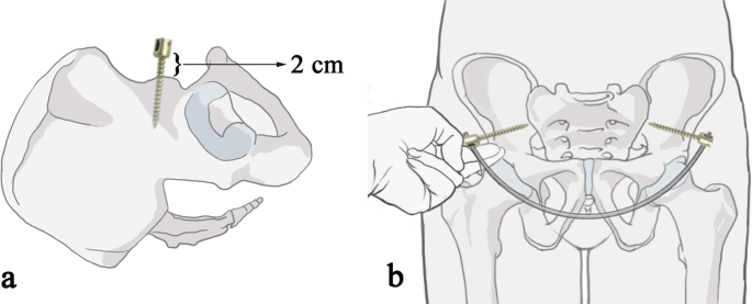 a 50-year-old male suffered an unstable pelvic ring injury due a... |  Download Scientific Diagram
