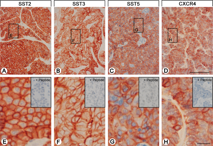 Different somatostatin and cxcr4 chemokine receptor expression in gastroenteropancreatic neuroendocrine neoplasms depending on their origin