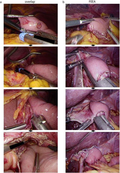 Three-dimensional stereoscopic visualization shortens operative time in laparoscopic gastrectomy for gastric cancer