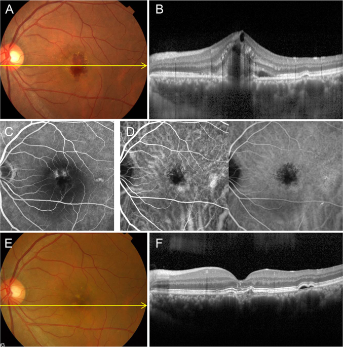 Risk Factors and Outcomes of Choroidal Neovascularization Secondary to ...