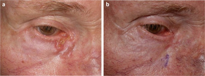 Electrochemotherapy in the treatment of locally advanced or recurrent