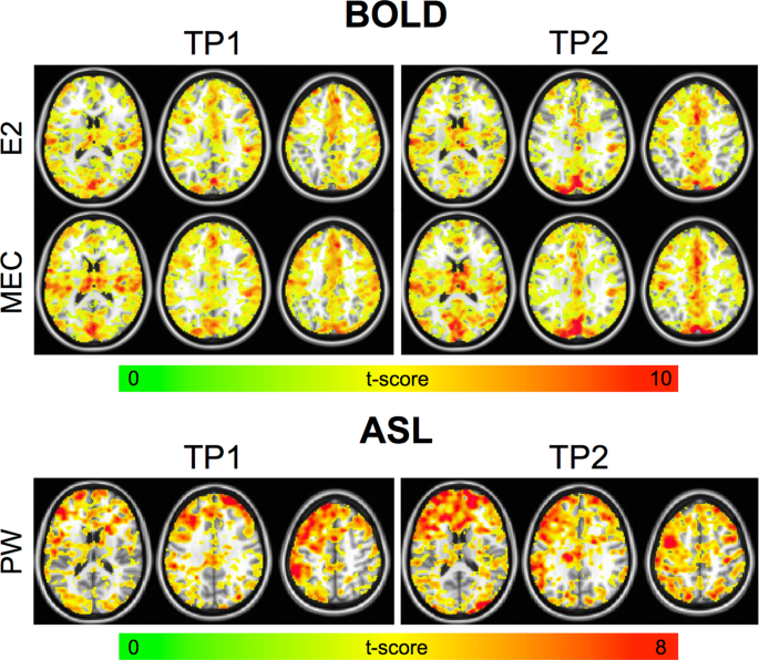 Improving the Assessment of Breath-Holding Induced Cerebral Vascular  Reactivity Using a Multiband Multi-echo ASL/BOLD Sequence | Scientific  Reports