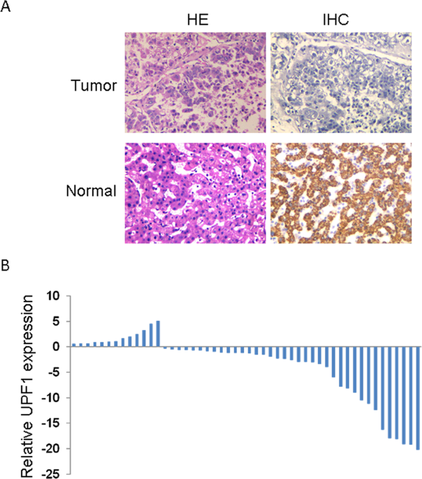 Upf1 inhibits the hepatocellular carcinoma progression by targeting long non-coding rna uca1