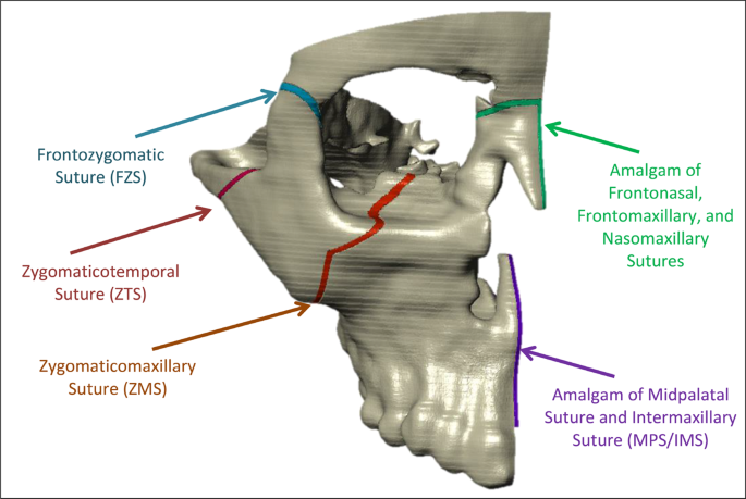 A comparative finite element analysis of maxillary expansion with and  without midpalatal suture viscoelasticity using a representative skeletal  geometry | Scientific Reports