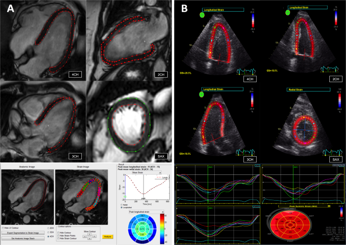 Strain Echocardiography part II: General concept 