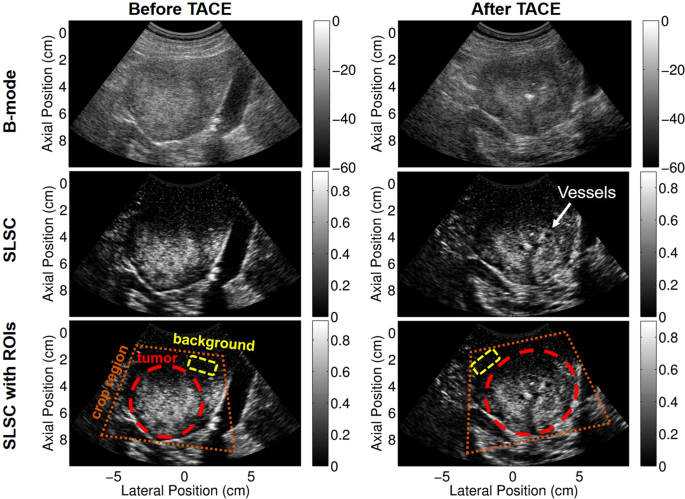 Non-contrast power Doppler ultrasound imaging for early assessment of  trans-arterial chemoembolization of liver tumors