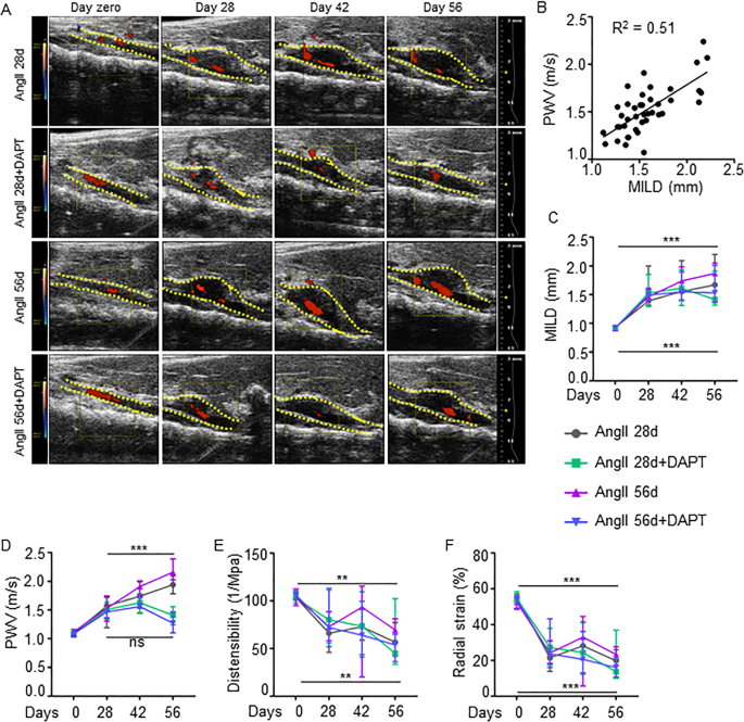 Pharmacological Inhibition Of Notch Signaling Regresses Pre