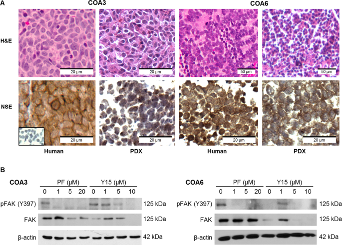 Focal Adhesion Kinase Inhibition Contributes to Tumor Cell Survival and Motility in Neuroblastoma Patient-Derived Xenografts