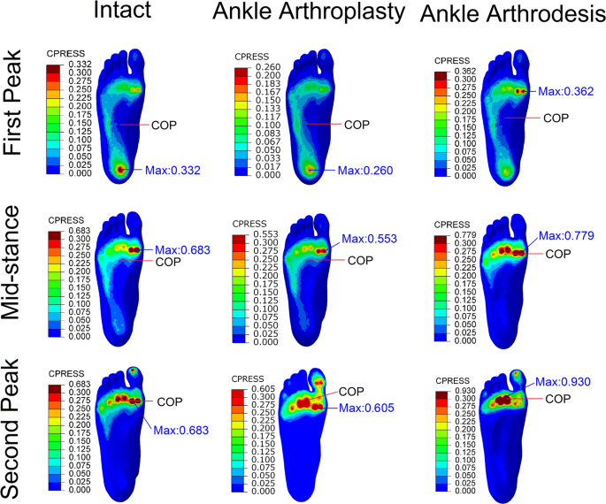 Total ankle arthroplasty and ankle arthrodesis affect the biomechanics of  the inner foot differently | Scientific Reports