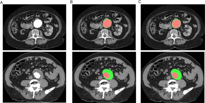 A fully automated pipeline for mining abdominal aortic aneurysm using image  segmentation | Scientific Reports