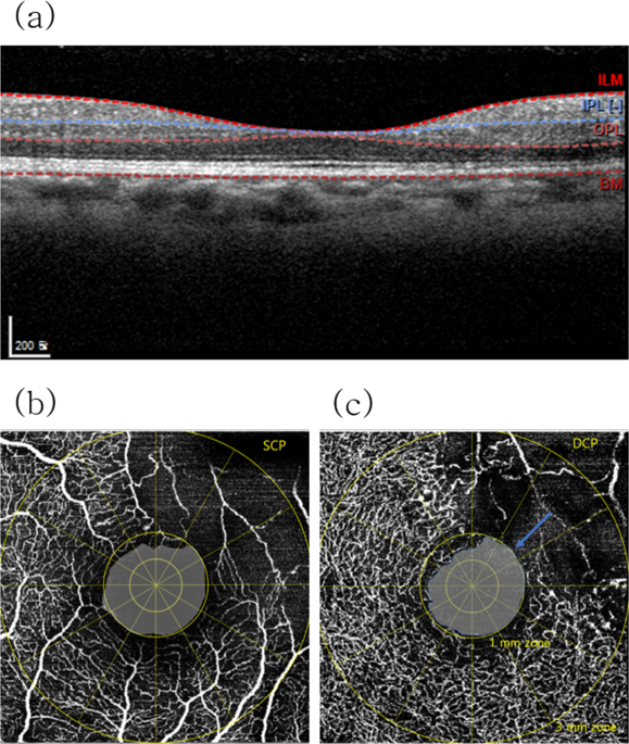 Oct Angiography Features Associated With Macular Edema Recurrence After Intravitreal Bevacizumab Treatment In Branch Retinal Vein Occlusion Scientific Reports Oct Angiography Features Associated With Macular Edema Recurrence After Intravitreal Bevacizumab Treatment In Branch Retinal Vein Occlusion Scientific Reports