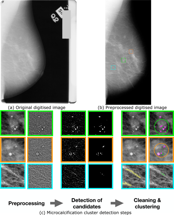Association of Microcalcification Clusters with Short-term
