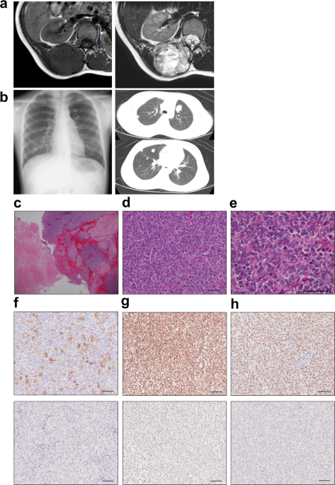 Establishment of a novel human CIC-DUX4 sarcoma cell line, Kitra ...