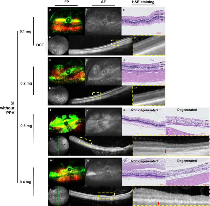 The effects of intravitreal sodium iodate injection on retinal degeneration following vitrectomy in rabbits