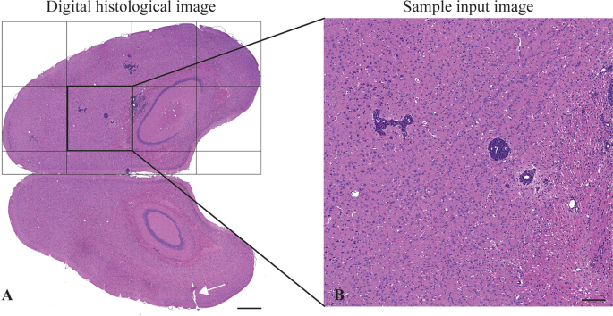 metastatic cancer detection)