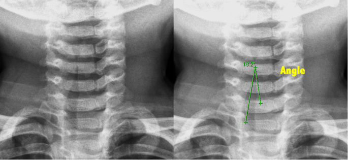 Steeple sign (trachea), Radiology Reference Article