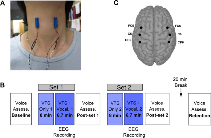 Laryngeal vibration as a non-invasive neuromodulation therapy for spasmodic dysphonia | Scientific Reports