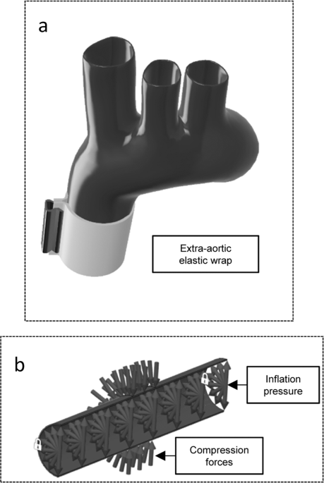 Computational evaluation of an extra-aortic elastic-wrap applied