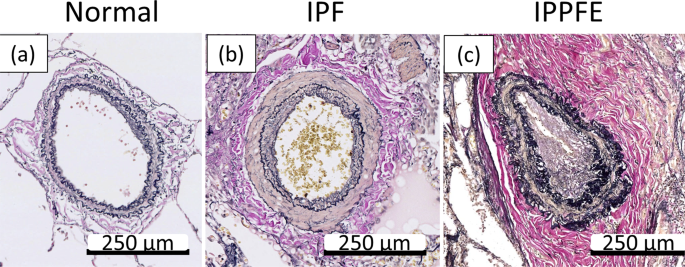 Remodeling of the pulmonary artery in idiopathic pleuroparenchymal fibroelastosis