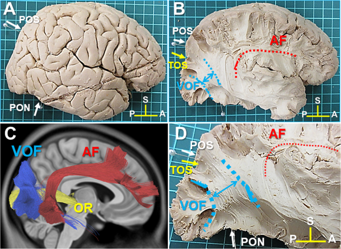 White matter dissection and structural connectivity of the human vertical  occipital fasciculus to link vision-associated brain cortex | Scientific  Reports