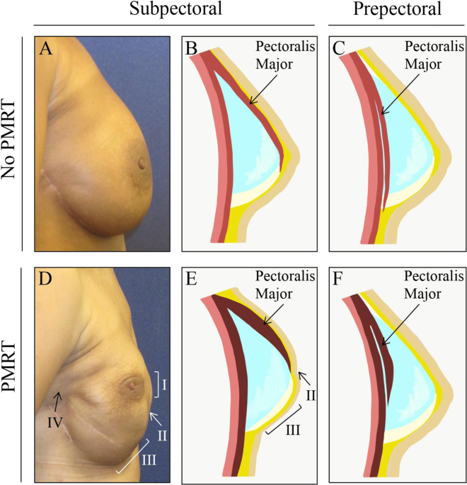 Evaluation of capsular contracture following immediate prepectoral versus  subpectoral direct-to-implant breast reconstruction | Scientific Reports