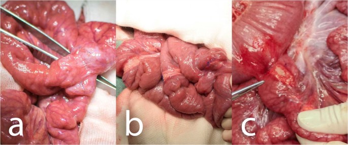 Laparoscopic pictures of the fibrinous adhesion, dark brownish ascetic