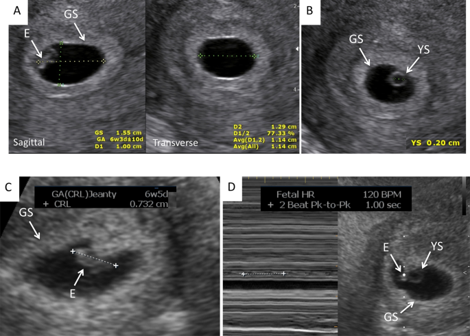 Early pregnancy ultrasound measurements and prediction of first trimester  pregnancy loss: A logistic model | Scientific Reports