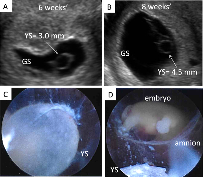 Gestational Sac in Pregnancy and Meaning If Empty