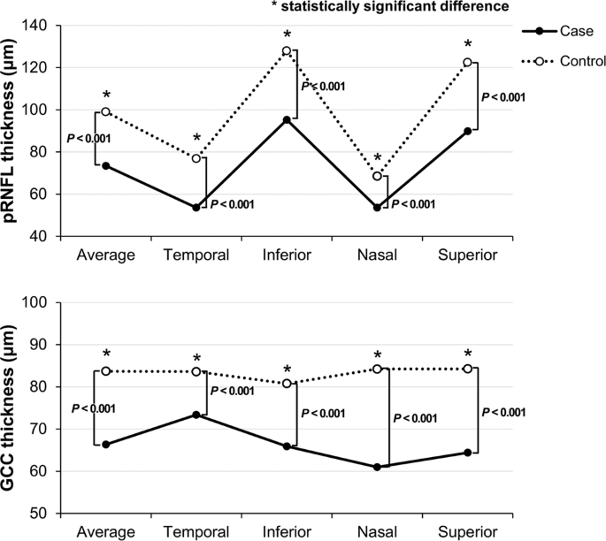 Analysis Of Optic Chiasmal Compression Caused By Brain Tumors Using Optical Coherence Tomography Angiography Scientific Reports