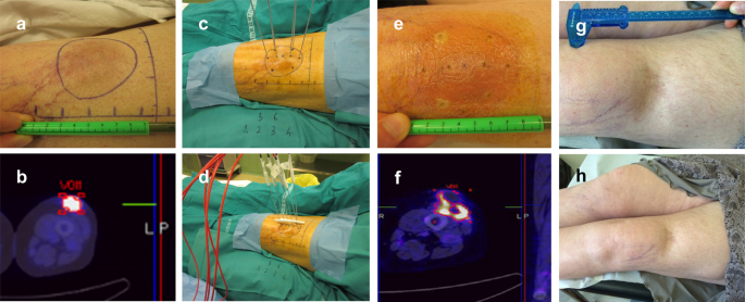 Ablation of soft tissue tumours by long needle variable electrode