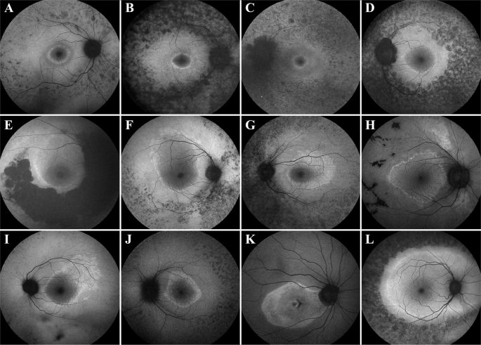 Disease asymmetry and hyperautofluorescent ring shape in retinitis  pigmentosa patients | Scientific Reports