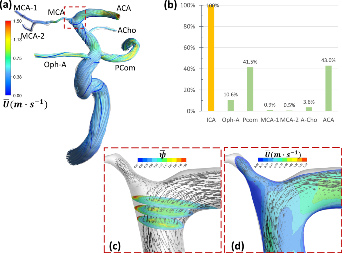 The Hemodynamic Complexities Underlying Transient Ischemic Attacks In Early Stage Moyamoya Disease An Exploratory Cfd Study Scientific Reports