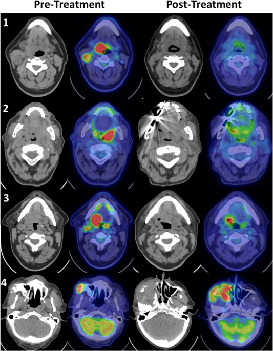 Post-treatment FDG PET-CT in head and neck carcinoma: comparative analysis  of 4 qualitative interpretative criteria in a large patient cohort |  Scientific Reports