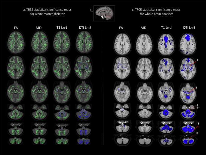 Hypoplasia Of Cerebellar Afferent Networks In Down Syndrome Revealed By Dti Driven Tensor Based Morphometry Scientific Reports