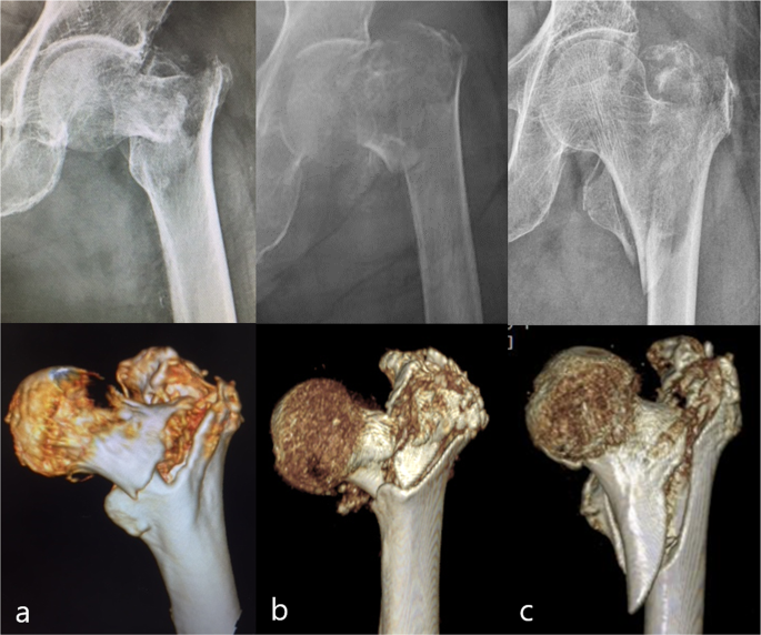 Gamma Nail - Hip Fracture - Recovery and Physical Therapy