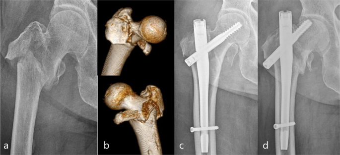 Short (175 mm) versus standard (220 mm) length intramedullary nail for  trochanteric hip fractures: a randomized trial of 229 patients | Bone &  Joint