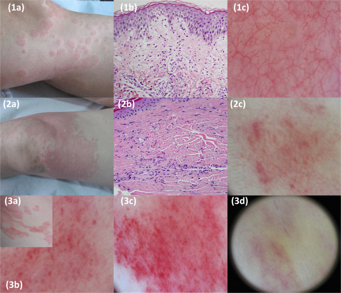 Development of a clinical-dermoscopic model for the diagnosis of urticarial vasculitis