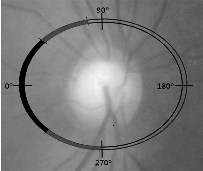 Characteristics Of Normal Tension Glaucoma Patients With Temporal Retinal Nerve Fibre Defects Scientific Reports Characteristics Of Normal Tension Glaucoma Patients With Temporal Retinal Nerve Fibre Defects Scientific Reports