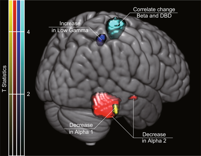 Non-pharmacological treatment changes brain activity in patients with  dementia
