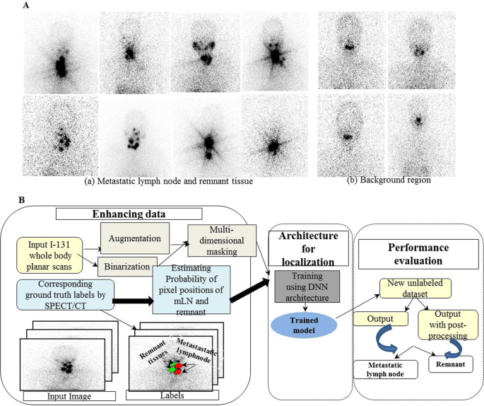 Deep Learning Enables Automated Localization Of The Metastatic Lymph Node  For Thyroid Cancer On 131I Post-Ablation Whole-Body Planar Scans |  Scientific Reports