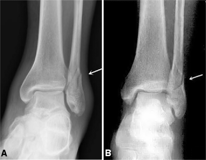 Radiographic analysis of adult ankle fractures using combined Danis-Weber  and Lauge-Hansen classification systems