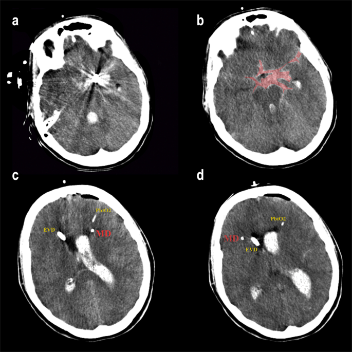 Imaging Evaluation of SAH and Aneurysm