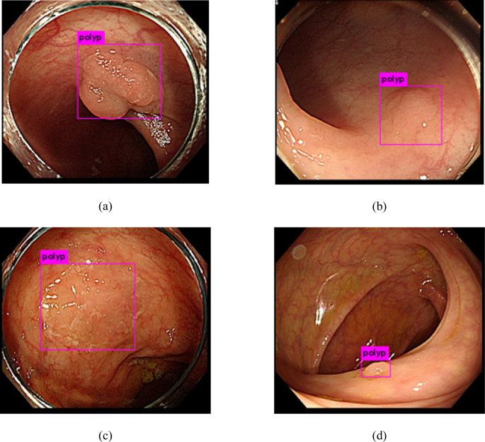 rectal polypectomy