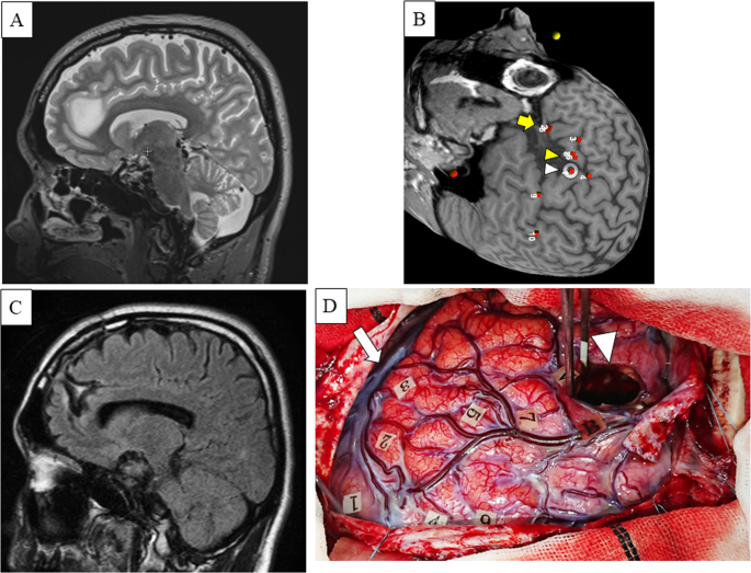 Perioperative Glycemia Management in Patients Undergoing Craniotomy for  Brain Tumor Resection: A Global Survey of Neuroanesthesiologists'  Perceptions and Practices - ScienceDirect