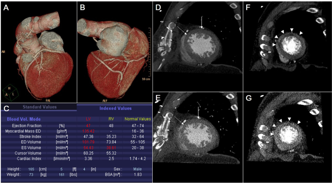 Clinical Utility Of Early Postoperative Cardiac Multidetector Computed Tomography After Coronary Artery Bypass Grafting Scientific Reports