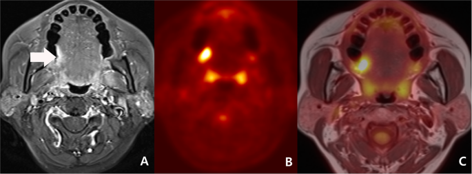 Diagnostic Accuracy and Confidence of [18F] FDG PET/MRI in comparison with PET or MRI in Head and Neck Cancer | Scientific Reports