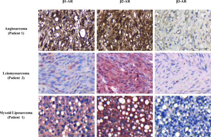 The B Adrenergic Receptor Antagonist Propranolol Offsets Resistance Mechanisms To Chemotherapeutics In Diverse Sarcoma Subtypes A Pilot Study Scientific Reports