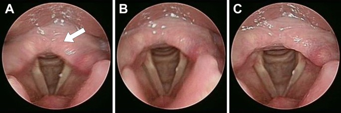 Laryngopharyngeal reflux image quantization and analysis of its severity |  Scientific Reports