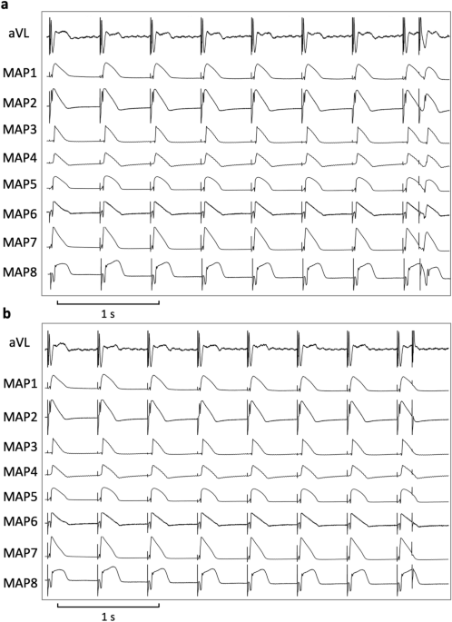 Propofol abolishes torsade de pointes in different models of acquired long qt syndrome