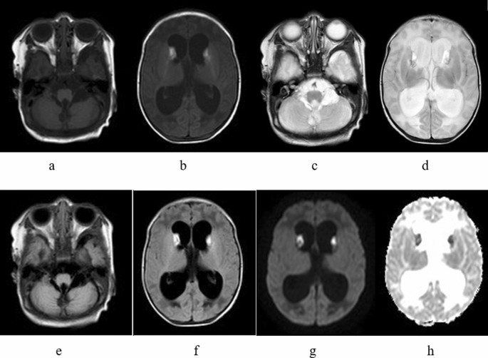 Brain MRI features of methylmalonic acidemia in children: the relationship  between neuropsychological scores and MRI findings | Scientific Reports